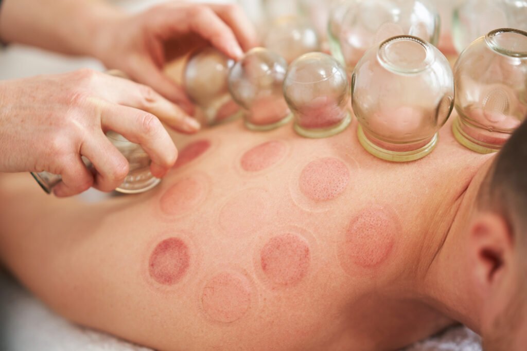 Terapia con ventosas (Cupping)