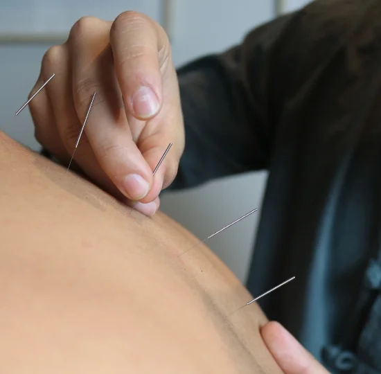 servicio acupuntura.jpg